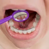 Fixed Retainers